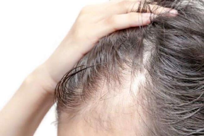 alopecia da trazione